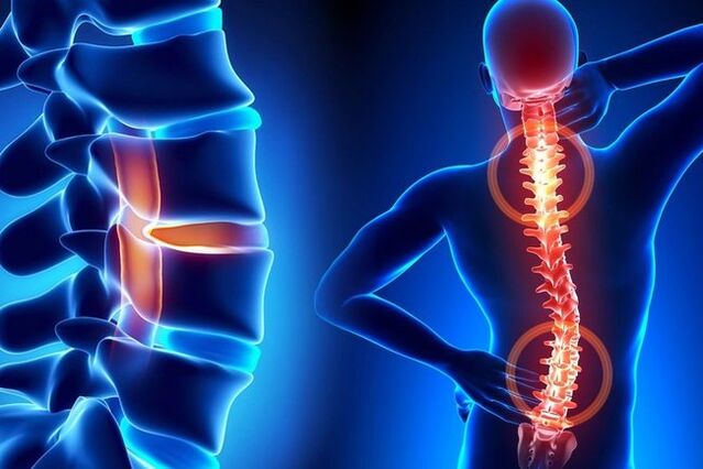 Osteochondrosis an spine